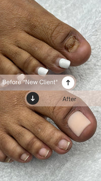 Toenail Reconstruction